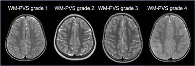 Brain perivascular spaces and autism: clinical and pathogenic implications from an innovative volumetric MRI study